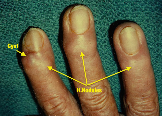 MUCOUS CYST | Hand Surgery Resource